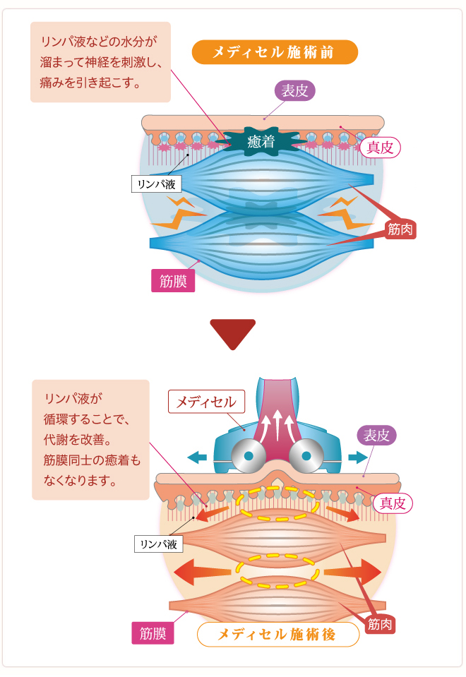 メディセル療法とは